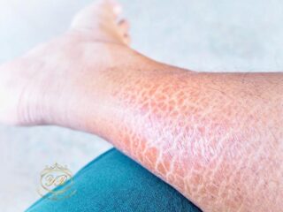 ایکتیوز و درمان آن