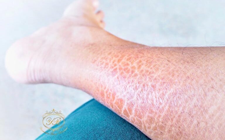 ایکتیوز و درمان آن