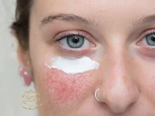 درمان رزاسه در کلینیک یاسمن رئیسی