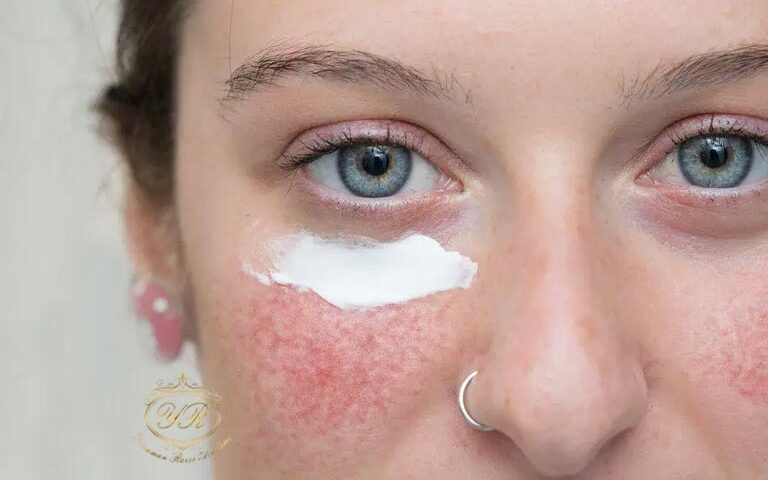 درمان رزاسه در کلینیک یاسمن رئیسی