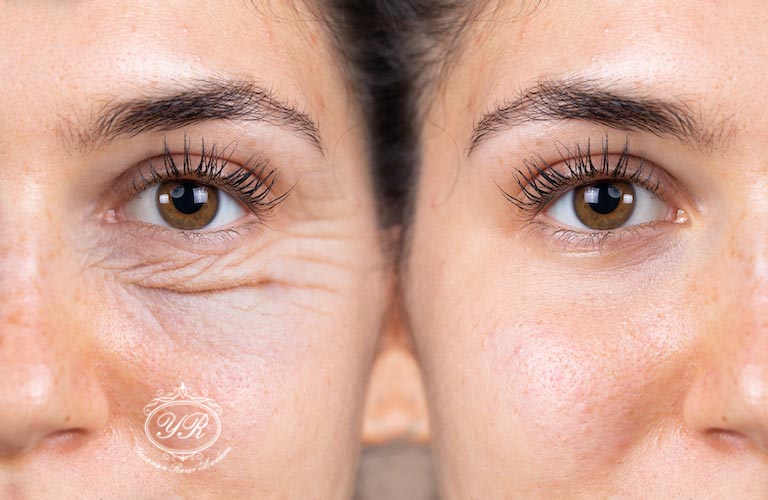 جوانسازی پوست در کلینیک یاسمن رئیسی در شیراز